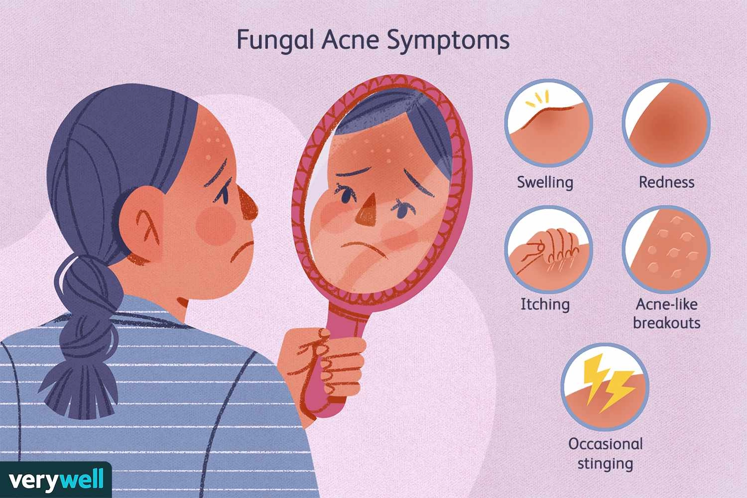 How To Identify Fungal Acne Ansiklopedia Usa Information Support Platform 